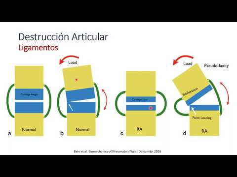 Fisiopatología y biomecánica de las deformidades de la mano por artritis reumatoide