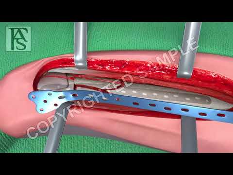 Broken Leg Surgery Femur Fracture Animation