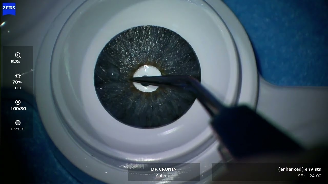 The HumanOptics artificial iris, explained by Dr Brendan Cronin