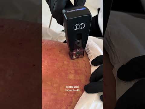 Morpheus8 no pós-parto: abdome, estrias e seios — vídeo do Dr. Thiago Perfeito