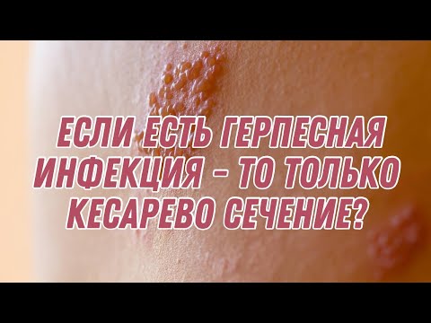 Кесарево сечение, если есть герпесная инфекция? #doctorberezovska #olenaberezovska #кесарево #герпес