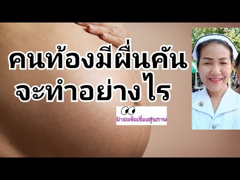 วีดีโอ: วิธีรักษาอาการแพ้ระหว่างตั้งครรภ์