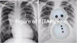 Snowman ☃️ (Figure of 8)TAPVR