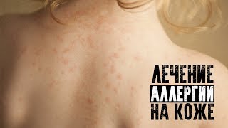 Лечение аллергии на коже Лечение аллергии на коже