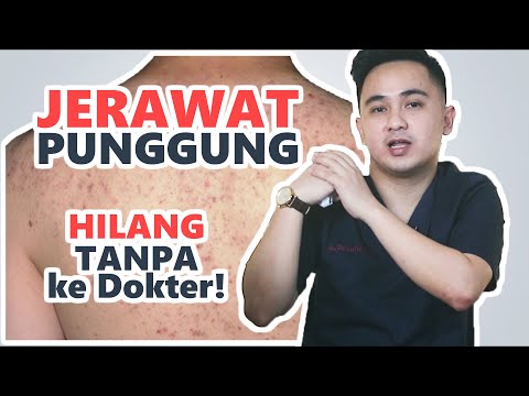 Video: Jerawat Kistik Di Punggung: Penyebab Dan Pengobatan