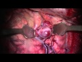 水谷無血手術　大型 (17mm ) 中大脳動脈瘤クリッピング（血管治療不可）/Bloodless cerebral aneurysm clipping by MIZUTANI