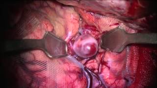 水谷無血手術　大型 (17mm ) 中大脳動脈瘤クリッピング（血管治療不可）/Bloodless cerebral aneurysm clipping by MIZUTANI