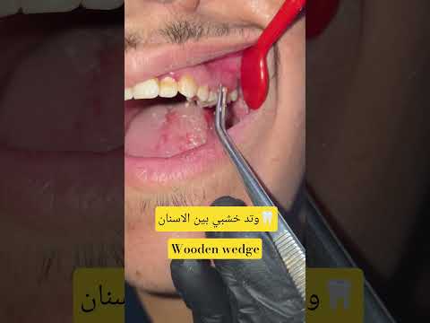 وتد خشبي محصور بين الاسنان    