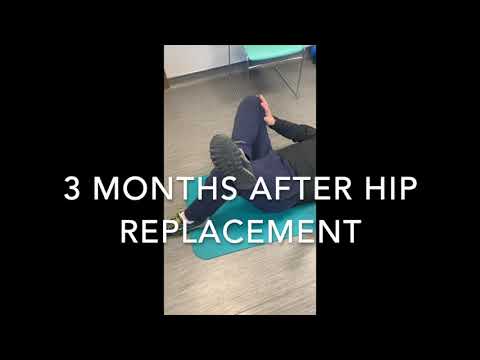 Recovery After Total Hip Replacement- Dual Mobility