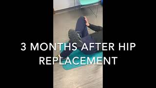 Recovery After Total Hip Replacement- Dual Mobility