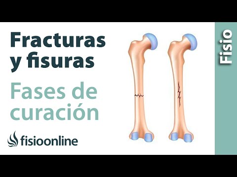 Vídeo: Fractura Triquetral: Síntomas, Causas, Tratamiento Y Tiempo De Curación