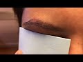 5 Months Early Asian Eyebrow Hair Transplant HD CloseUp
