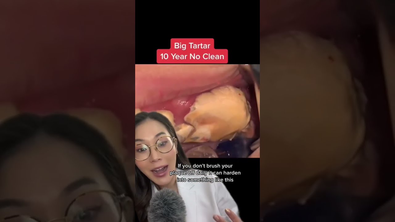 Look At This Huge Piece Of Calculus Plaque Tartar Dentalcleaning Dentistry