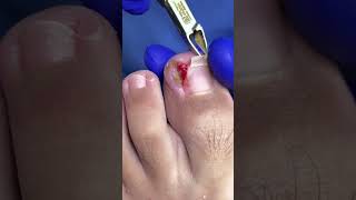 Extracción de uña encarnada en paciente de 13 años de edad! #uñaencarnada