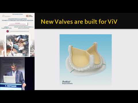 Γ.Παττακός  | Νέες βιολογικές βαλβίδες σχεδιασμένες για μελλοντικές valve in valve – το μέλλον τω...