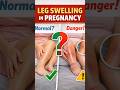 #legswelling #pregnancy #trendingshorts #tamilreels #obstetriciangynecologist