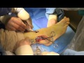 Ankle Fracture Surgery Video | Dr. Moore Using Stryker 'VariAx Fibula' Plating System
