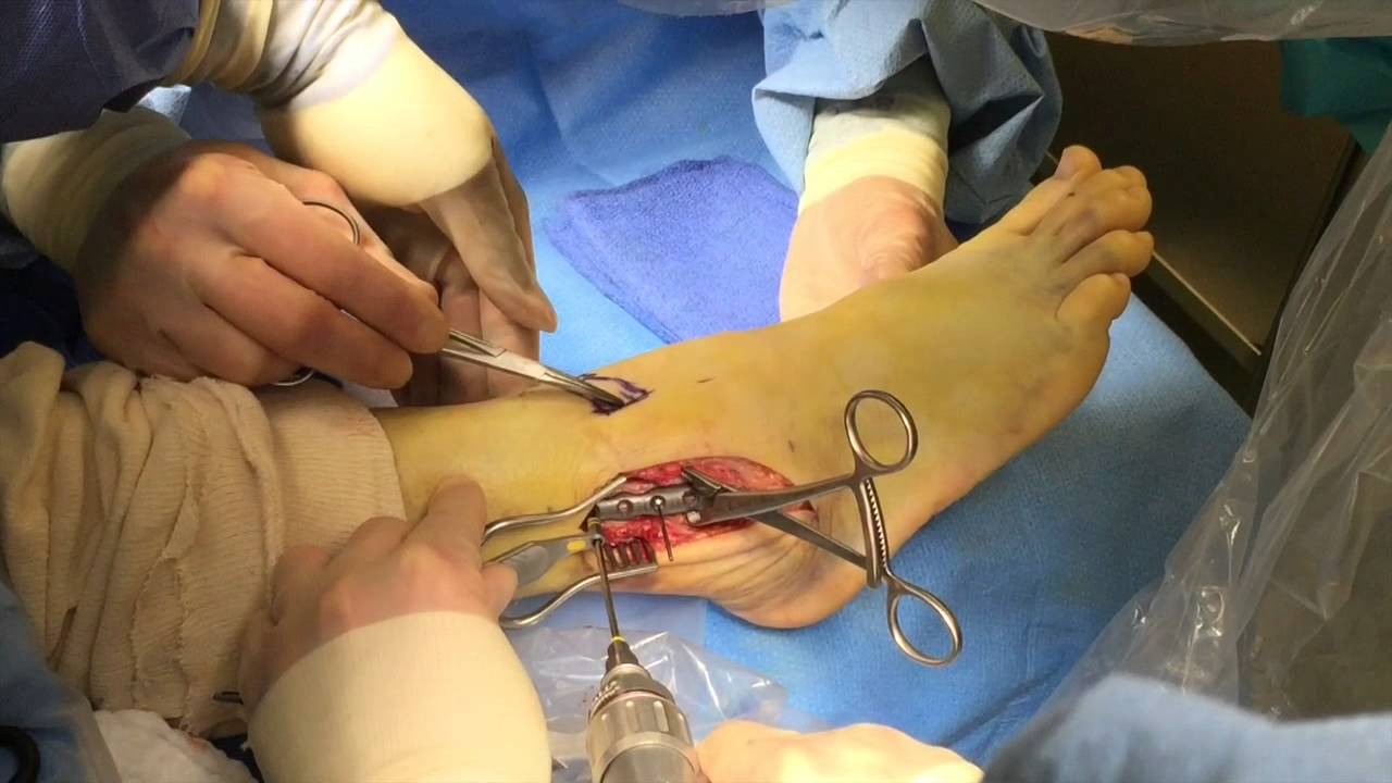 What are some important things to know about ankle ligament reconstruction surgery?