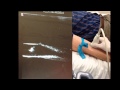 ULTRASOUND GUIDED CANNULATION