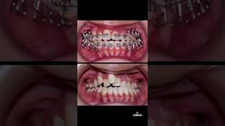 Leffet Magique De Lorthodontie