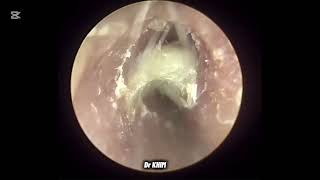 ASMR 고막에 붙은 딱딱한 귀지 제거 (Hard Earwax Removal) #earcleaning #asmr #satisfying #earwax removal