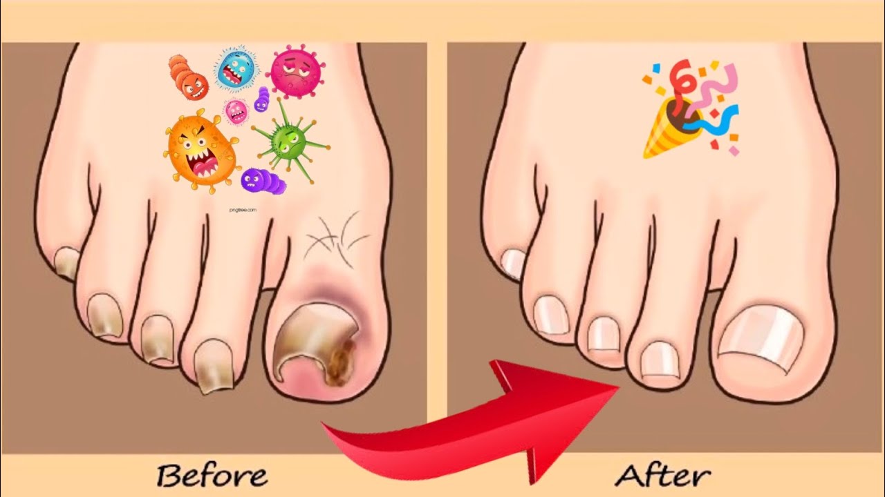 ASMR Coolness! Ingrown Toenail removal treatment animation 😱 Asmr