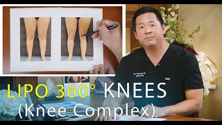 Virtual Consultation | Lipo 360 Knees | Leg Liposuction | Lipedema Surgery | Artlipo | Expert Dr. Su