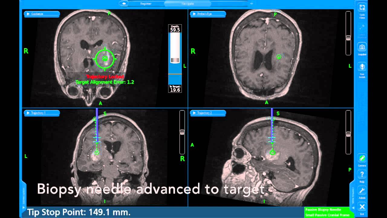 Insular High Grade Glioma stereotactic Biopsy YouTube insular-high-grade-glioma-stereotactic-biopsy-youtube