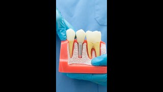 Can you get Dental Implants when you've had a loss of bone?