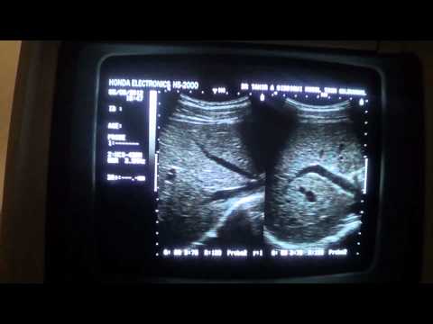 ultrasound portal vs hepatic veins for begenners