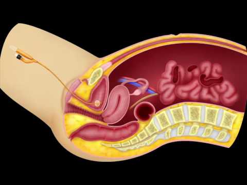 Complications Of Laparoscopic Surgery