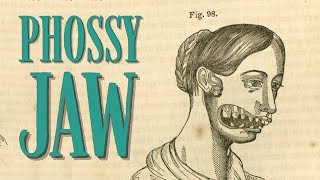 Phossy jaw was utterly horrific | Brief Histories