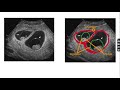 Anatomy of monochorionic diamniotic twin pregnancy