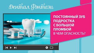 👉 Постоянный зуб подростка с большой пломбой. В чем опасность?