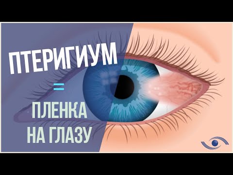 ПТЕРИГИУМ ГЛАЗА: лечение птеригиума в Новосибирске!