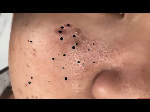 Video: Blackheads On Cheeks: At-Home And Professional Treatments