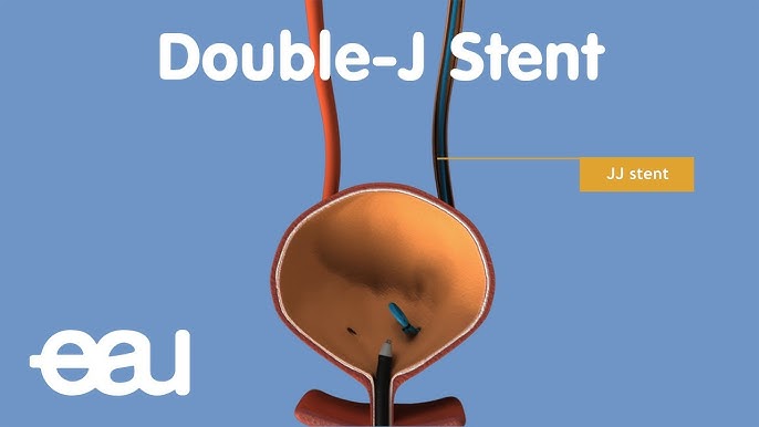 Sonde urinaire en « double J »