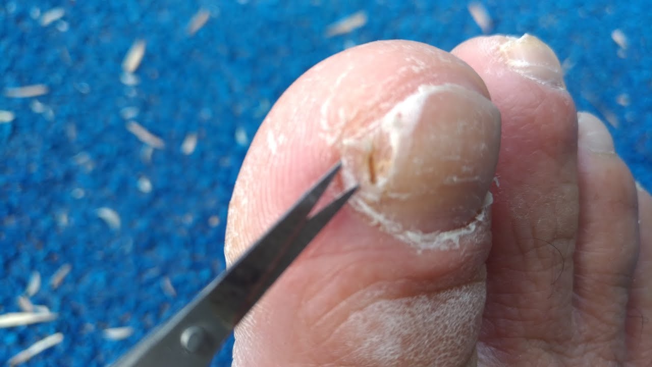 DIY Remove Onychomycosis (Toenail Fungus) with a nail clipper and manicure scissors 除去灰指甲 YouTube