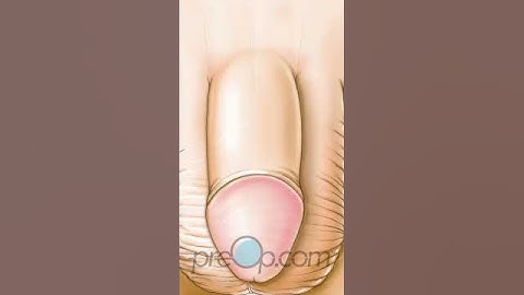 ✂️ The Non-Scalpel Vasectomy Explained 📋🌟✅