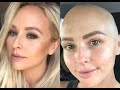 Insta influencer &#39;Doctors said I was too young to have cancer, then I had to have my breast removed&#39;