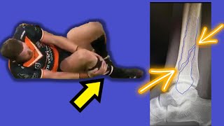 Jackson Hastings Broken Fibula Explained!