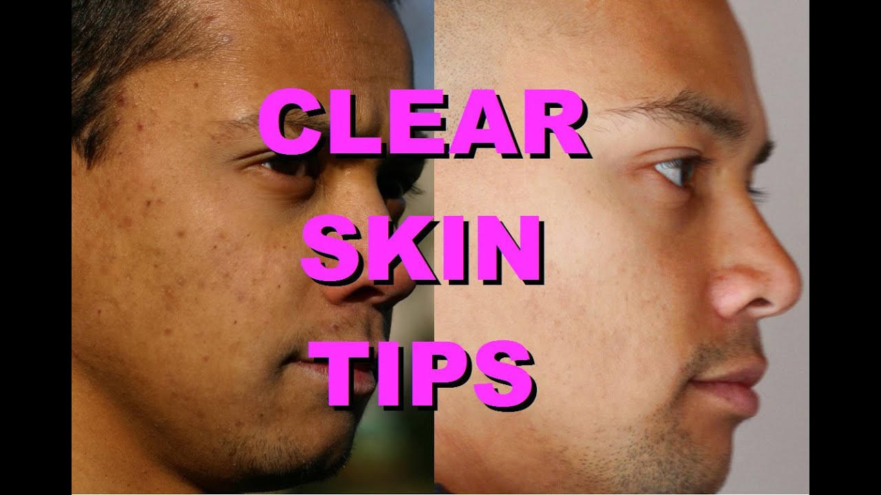 How To Get Clear Skin: Tips For Acne Free Spotless Skin - YouTube