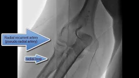radial artery loop - radial recurrent artery