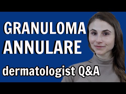 Granuloma annulare: treatments and causes: dermatologist Dr Dray