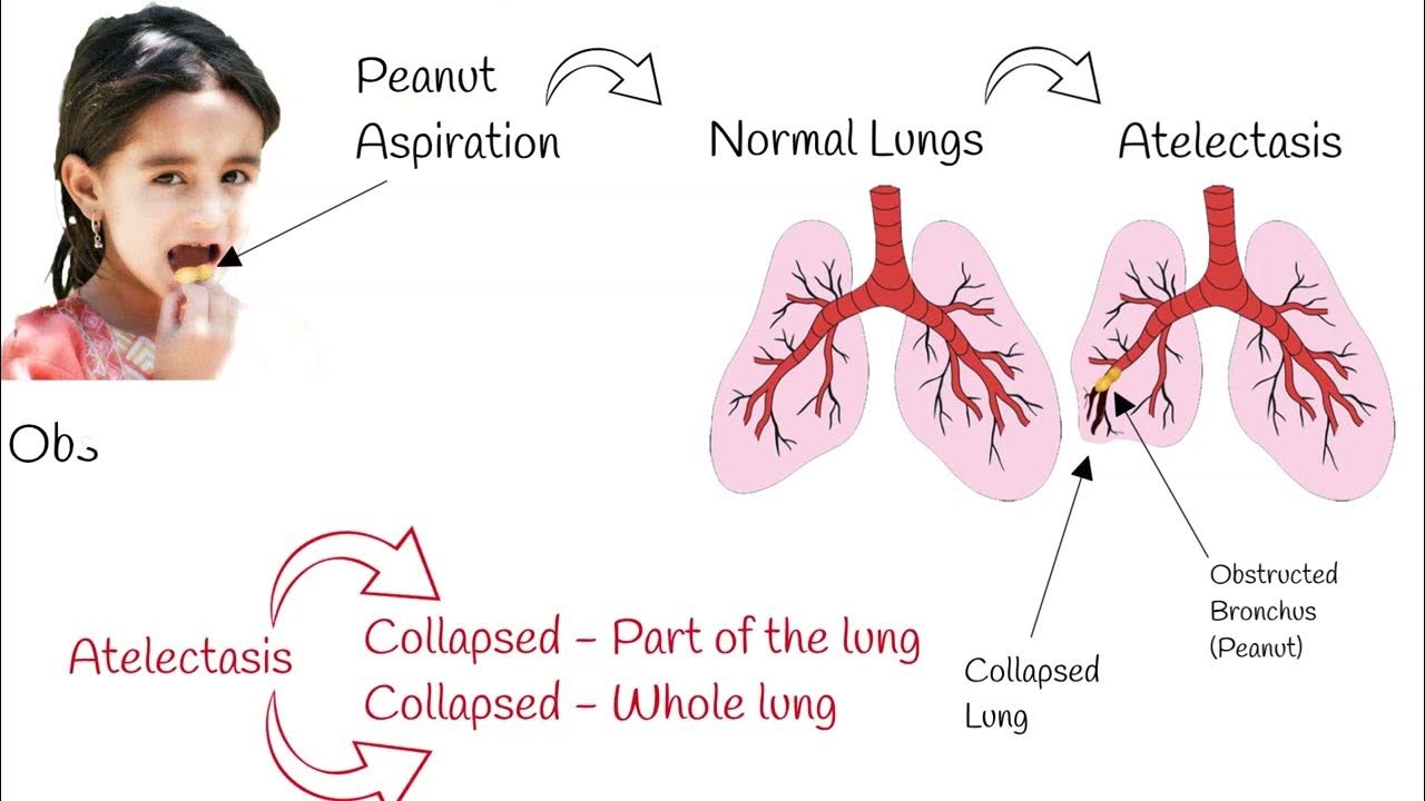 Atelectasis signs and symptoms mechanism of atelectasis explained