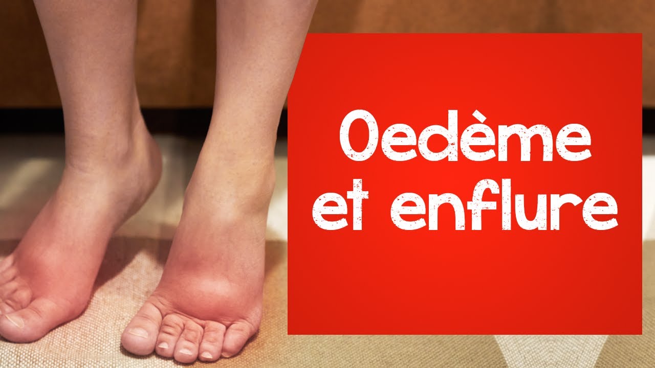 Oedème et enflure: tu devrais faire ceci (pour régler le problème  maintenant)