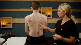 From Red to Purple: Unveiling the Secrets of Cupping Marks