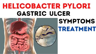 Helicobacter Pylori infection pathogenesis treatment screenshot 1