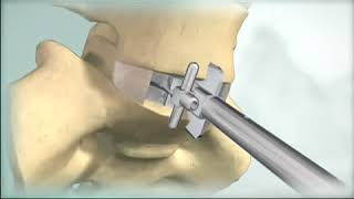 DePuySynthes (Synthes): Spine ProDisc L Lumbar Total Disc Replacement Animation