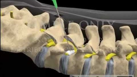 Lumbar Spine Selective Nerve Root Block Injection pain management movies